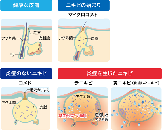 ニキビの進行